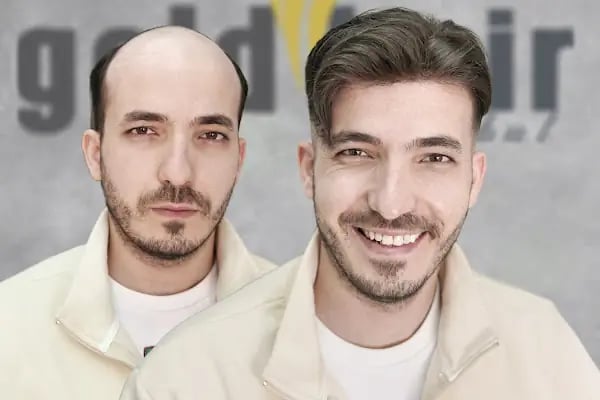 Gold Hair İstanbul - Protez Saç ve Gerçek Saç Merkezi | Real Hair Replacement Center - Resim 5