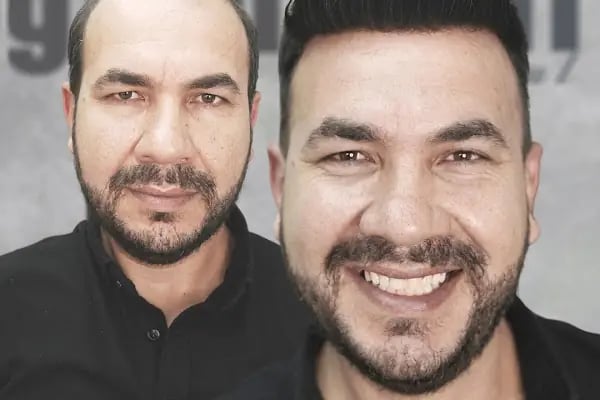 Gold Hair İstanbul - Protez Saç ve Gerçek Saç Merkezi | Real Hair Replacement Center - Resim 16