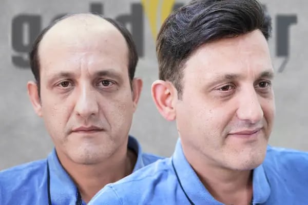 Gold Hair İstanbul - Protez Saç ve Gerçek Saç Merkezi | Real Hair Replacement Center - Resim 11