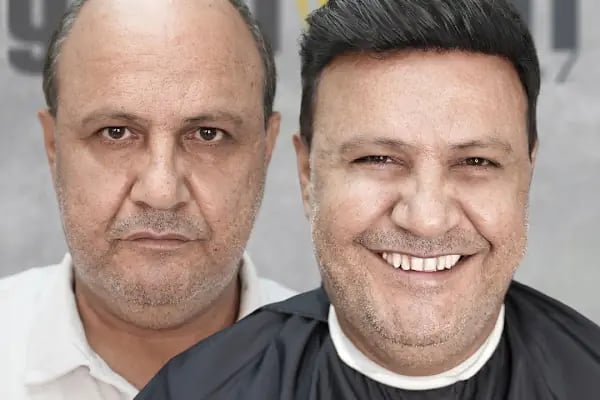 Gold Hair İstanbul - Protez Saç ve Gerçek Saç Merkezi | Real Hair Replacement Center - Resim 8