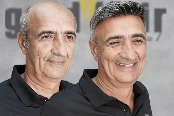Gold Hair İstanbul - Protez Saç ve Gerçek Saç Merkezi | Real Hair Replacement Center - Resim 3