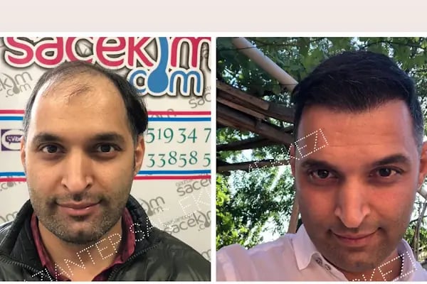 Serap Lazer Epilasyon &amp; Güzellik Salonu Birecik - Resim 9