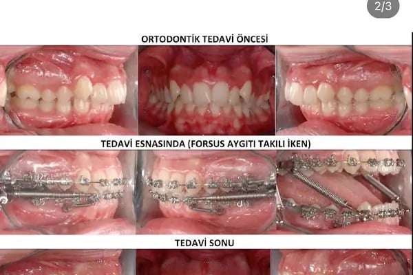 ARTI ORTODONTİ ESTETİK AĞIZ VE DİŞ SAĞLIĞI POLİKLİNİĞİ - Resim 10