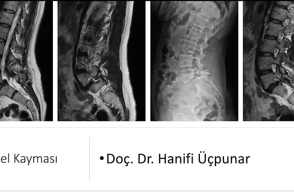 Doç. Dr. Hanifi ÜÇPUNAR - Medical Park Bursa Hastanesi - Ortopedi ve Omurga Cerrahisi - Resim 18