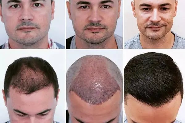 Siverek saç ekim merkezi - Resim 4