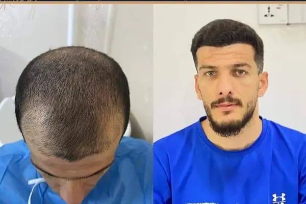 Siverek saç ekim merkezi - Resim 5