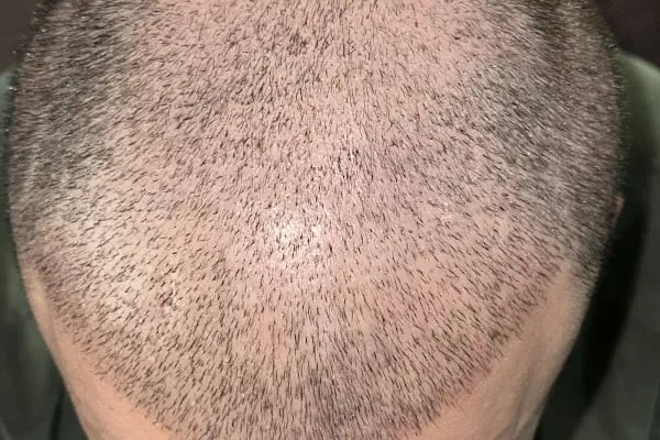 Saç Ekimi - Hair Transplant - Resim 1