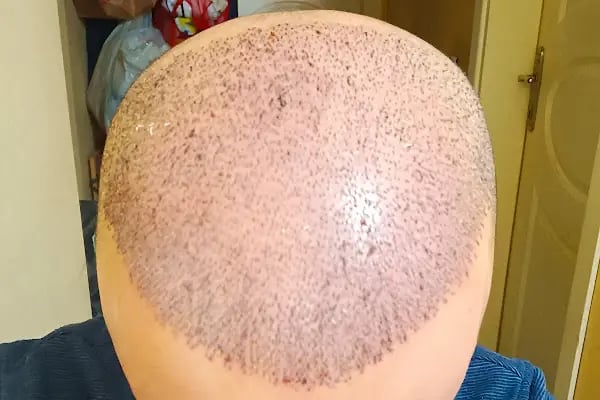 Saç Ekimi - Hair Transplant - Resim 11