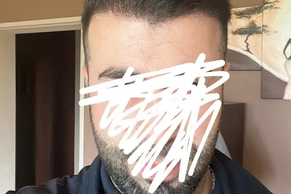 Saç Ekimi - Hair Transplant - Resim 13