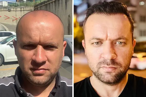Saç Ekimi - Hair Transplant - Resim 19