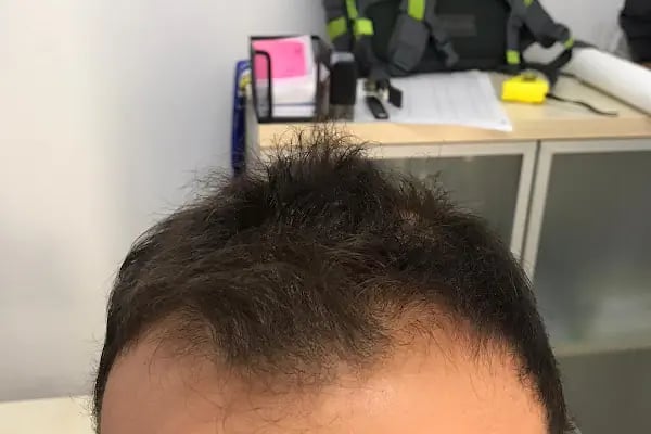 Saç Ekimi - Hair Transplant - Resim 17