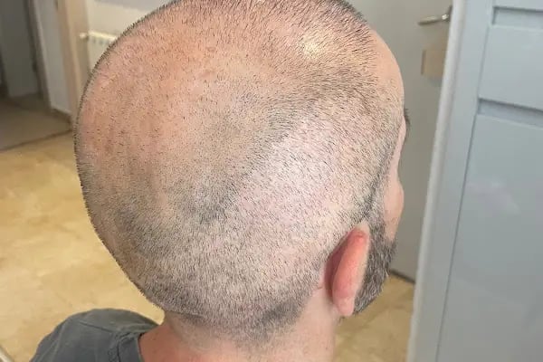 Saç Ekimi - Hair Transplant - Resim 8