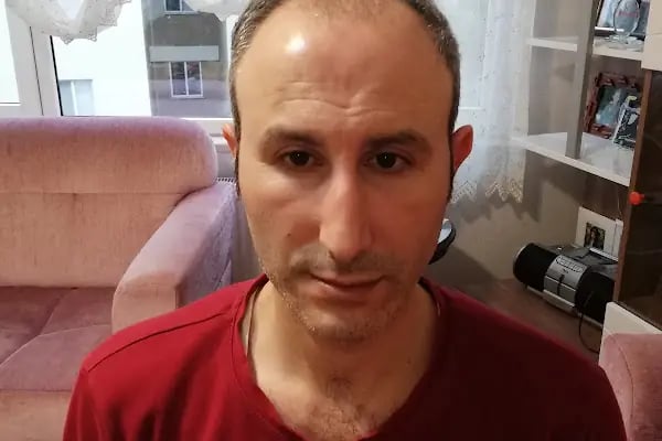 Saç Ekimi - Hair Transplant - Resim 9