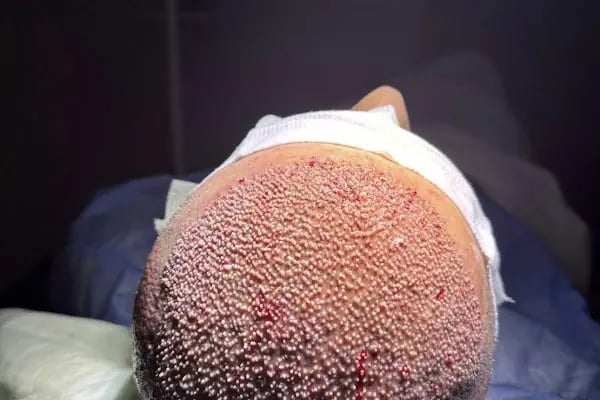 Saç Ekimi - Hair Transplant - Resim 16