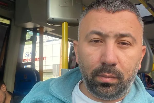 Saç Ekimi - Hair Transplant - Resim 15