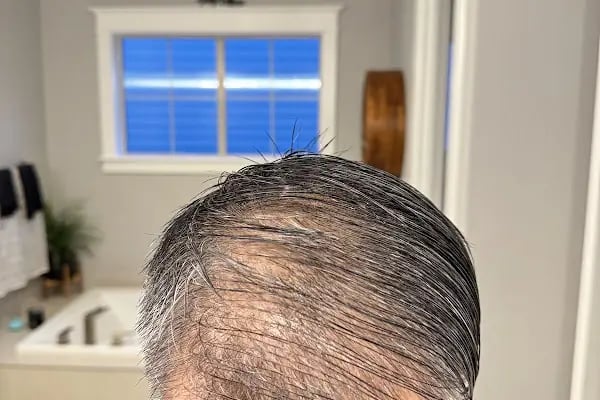 Saç Ekimi - Hair Transplant - Resim 10