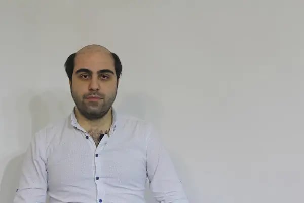 saç protez merkezi - Resim 18