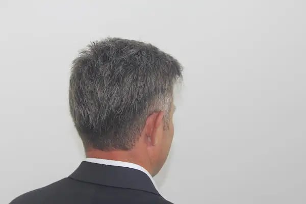 saç protez merkezi - Resim 4