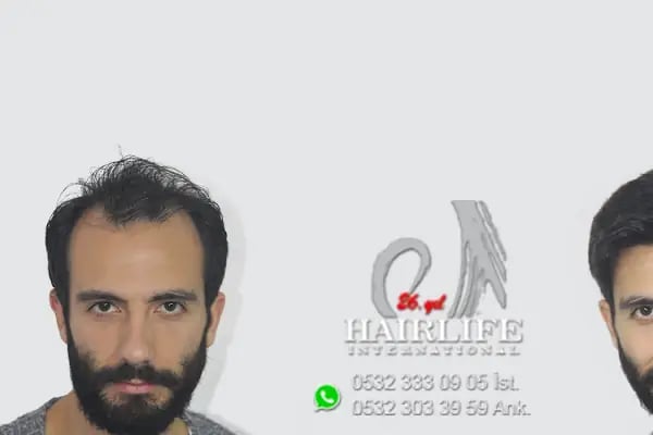 saç protez merkezi - Resim 2