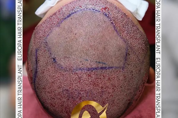 AVRUPA SAÇ EKİMİ - AVRUPA HAİR TRANSPLANT.|Greffe de Cheveux Turquie | Trasplante Capilar Turquia | Пересадка Волос в Турции - Resim 20