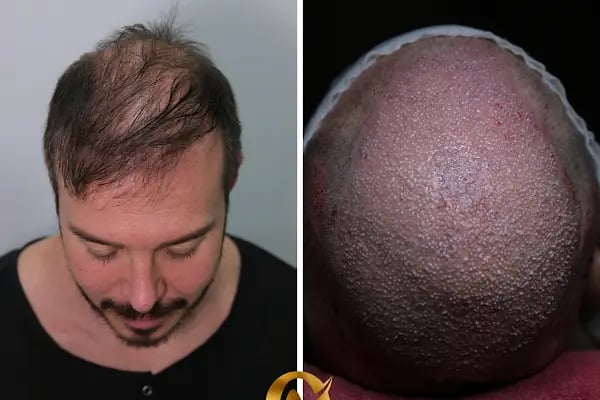 AVRUPA SAÇ EKİMİ - AVRUPA HAİR TRANSPLANT.|Greffe de Cheveux Turquie | Trasplante Capilar Turquia | Пересадка Волос в Турции - Resim 1