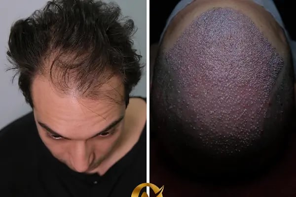 AVRUPA SAÇ EKİMİ - AVRUPA HAİR TRANSPLANT.|Greffe de Cheveux Turquie | Trasplante Capilar Turquia | Пересадка Волос в Турции - Resim 6