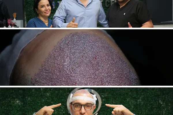 AVRUPA SAÇ EKİMİ - AVRUPA HAİR TRANSPLANT.|Greffe de Cheveux Turquie | Trasplante Capilar Turquia | Пересадка Волос в Турции - Resim 2