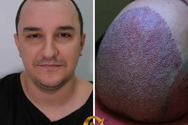 AVRUPA SAÇ EKİMİ - AVRUPA HAİR TRANSPLANT.|Greffe de Cheveux Turquie | Trasplante Capilar Turquia | Пересадка Волос в Турции - Resim 4