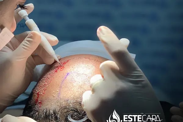 Este Çapa - Resim 7