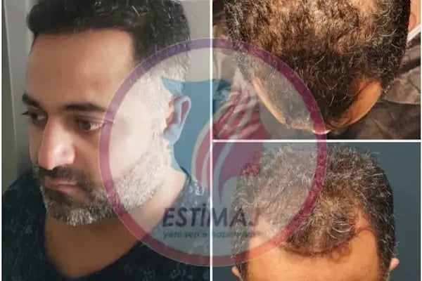 A Plus Hair Transplant &amp; Hair Clinic Saç Ekim Merkezi - Resim 14