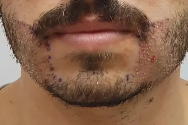 A Plus Hair Transplant &amp; Hair Clinic Saç Ekim Merkezi - Resim 13