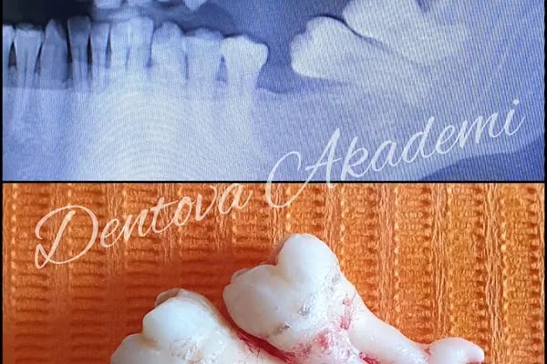 DENTOVA ESTETİK - Konya İmplant, Diş Teli, Çocuk Diş Hekimliği, Konya Diş Hekimi - Resim 10