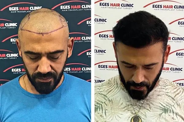 Bayraklı Saç Ekim Merkezi - İzmir Eges Hair Transplant - Resim 10