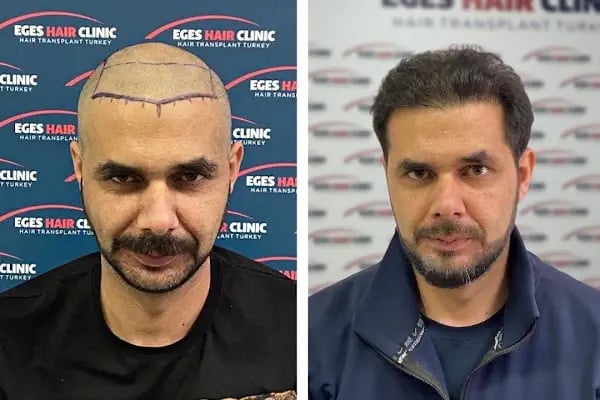 Bayraklı Saç Ekim Merkezi - İzmir Eges Hair Transplant - Resim 9