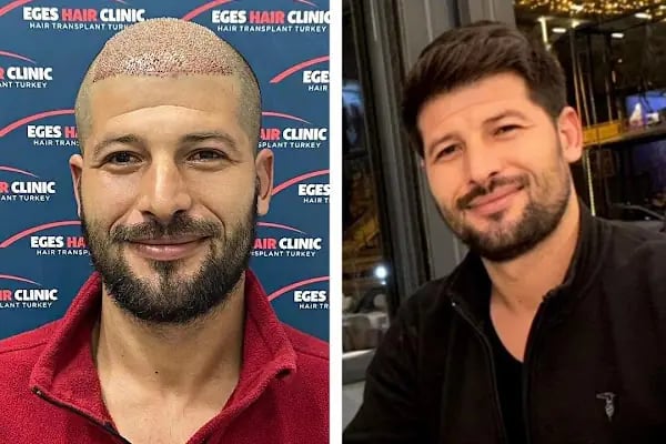 Bayraklı Saç Ekim Merkezi - İzmir Eges Hair Transplant - Resim 8