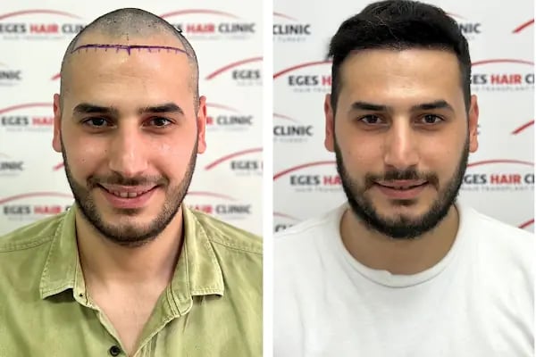 Bayraklı Saç Ekim Merkezi - İzmir Eges Hair Transplant - Resim 1
