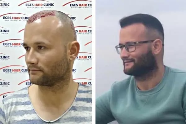 Bayraklı Saç Ekim Merkezi - İzmir Eges Hair Transplant - Resim 11