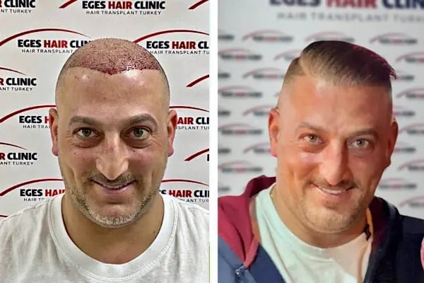 Bayraklı Saç Ekim Merkezi - İzmir Eges Hair Transplant - Resim 7