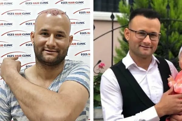Bayraklı Saç Ekim Merkezi - İzmir Eges Hair Transplant - Resim 5