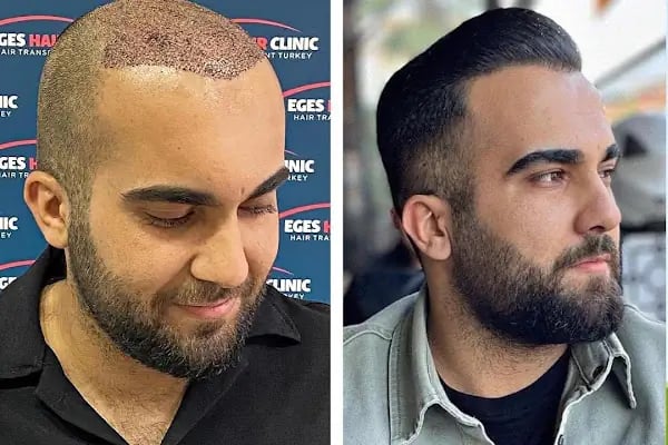 Bayraklı Saç Ekim Merkezi - İzmir Eges Hair Transplant - Resim 4