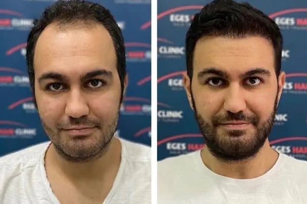 Bayraklı Saç Ekim Merkezi - İzmir Eges Hair Transplant - Resim 6