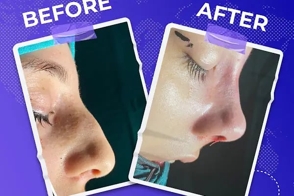 MediAvrupa Estetik / Burun Estetiği / Meme Estetiği / Popo Estetiği (BBL) /Liposuction/ Karın Germe/ MOMMY MAKEOVER/ - Resim 19