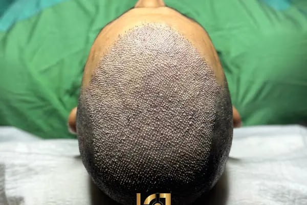 hair of diyarbakır - Resim 8
