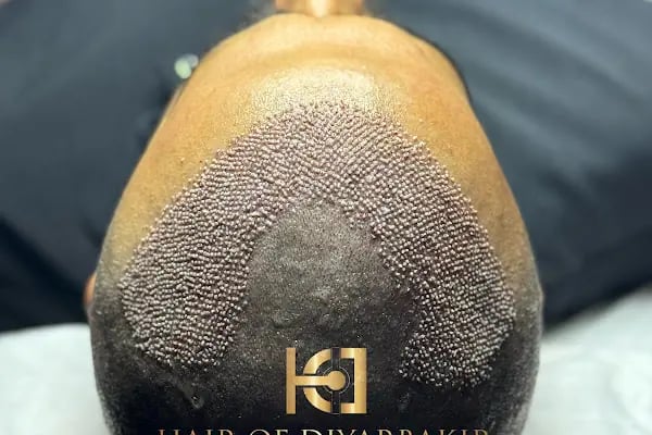 hair of diyarbakır - Resim 5