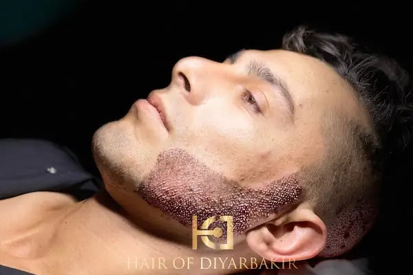 hair of diyarbakır - Resim 16