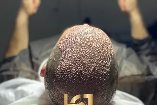 hair of diyarbakır - Resim 4
