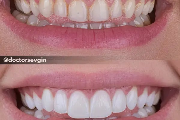 Gülüş Tasarımı - Estetik Diş Hekimi Sevgin ŞEN - Resim 15