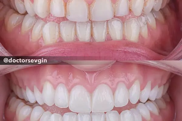 Gülüş Tasarımı - Estetik Diş Hekimi Sevgin ŞEN - Resim 12
