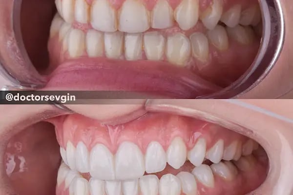 Gülüş Tasarımı - Estetik Diş Hekimi Sevgin ŞEN - Resim 17