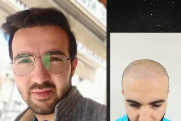 yordam hair saç ekim - Resim 3